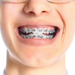 What is the Best Age for Kids to Get Braces?